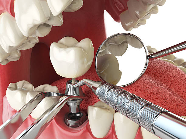 Best Emergency Broken Tooth Repair in Wappingers Falls, NY